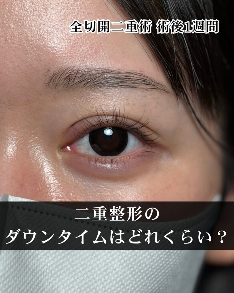 二重整形のダウンタイムはどれくらい？仕事復帰までの目安を解説