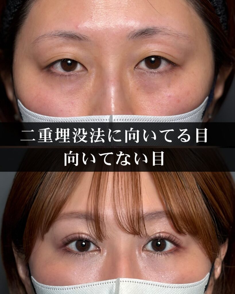 仙台の二重整形名医が徹底解説。二重埋没法に向いてる目、向いてない目