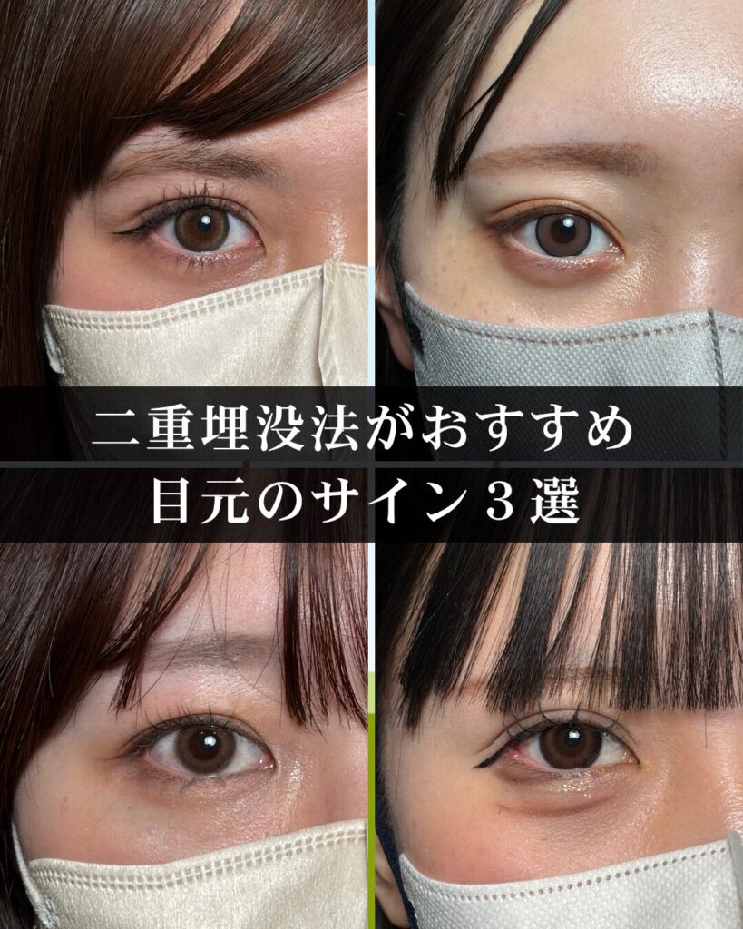 仙台の二重整形の名医が徹底解説。二重埋没法がおすすめの目元のサイン３選
