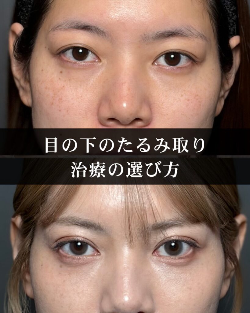 仙台で目の下のたるみ取りを考えている方へ。若返り治療の選び方