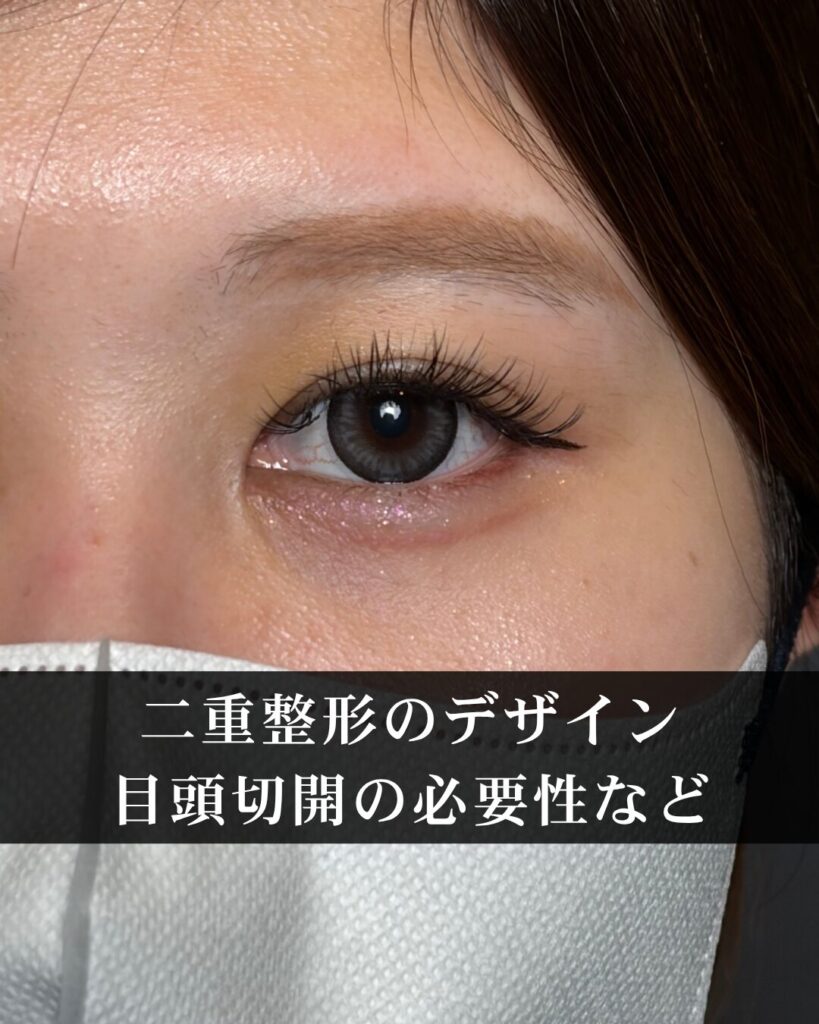 仙台で二重整形の名医が解説。二重整形のデザイン、目頭切開の必要性など