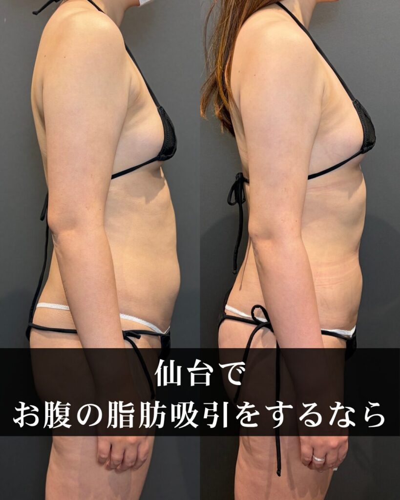 仙台の美容外科でお腹の脂肪吸引をするなら