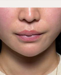 唇ヒアルロン酸　【施術直後一例】
