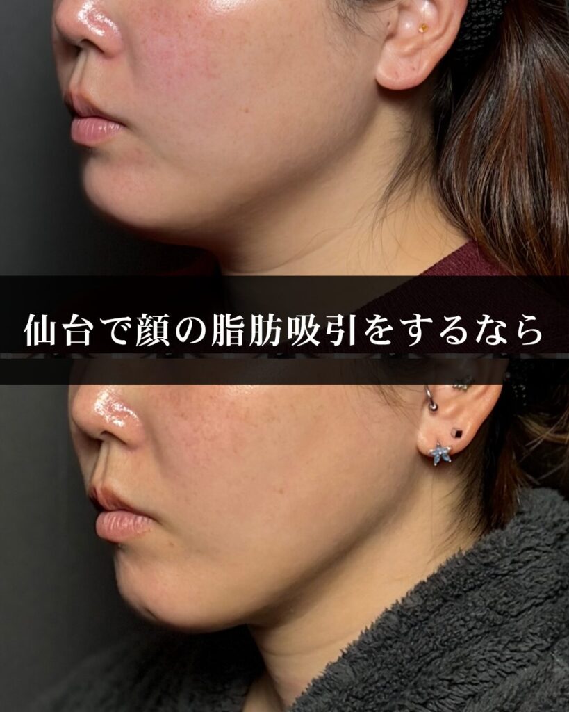 仙台の美容外科で顔の脂肪吸引をするなら