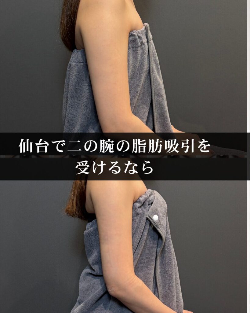 仙台で二の腕の脂肪吸引を受けるなら