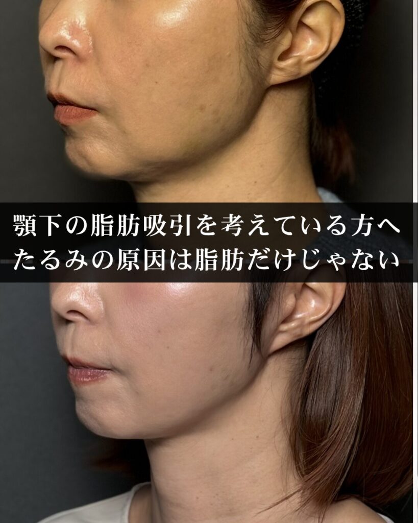 仙台で顎下の脂肪吸引を考えている方へ。たるみの原因は脂肪だけではありません。