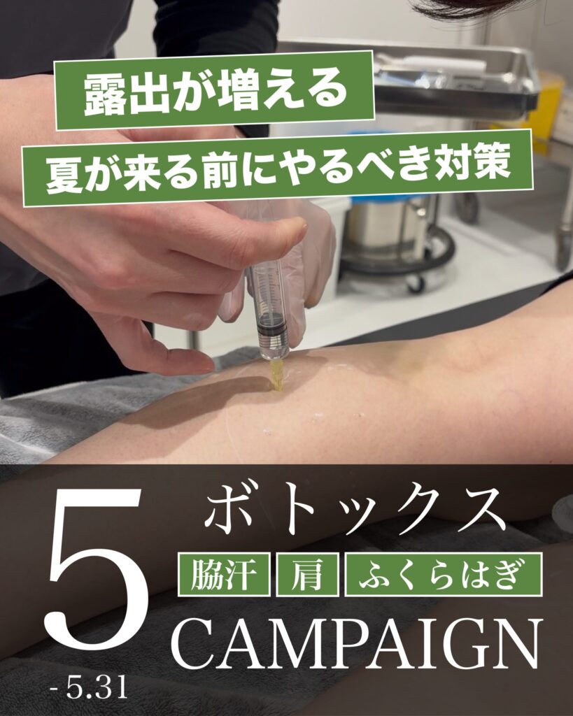 【仙台で5月限定】脇汗・肩こり・ふくらはぎ｜ボトックスキャンペーン実施中