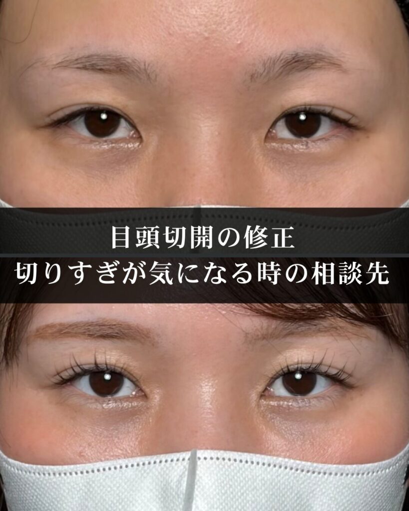 仙台で目頭切開の修正を考えている方へ|切りすぎが気になる時の相談先と知っておきたいこと