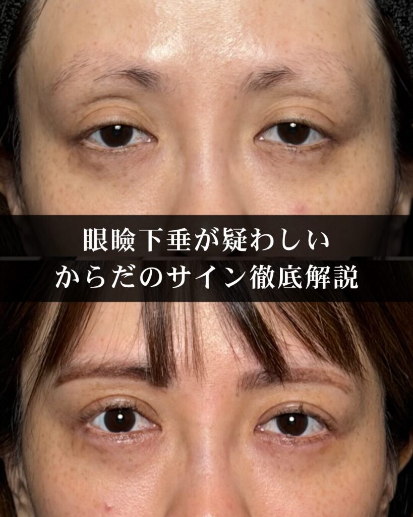 仙台の美容外科医が徹底解説。眼瞼下垂が疑わしいからだのサイン