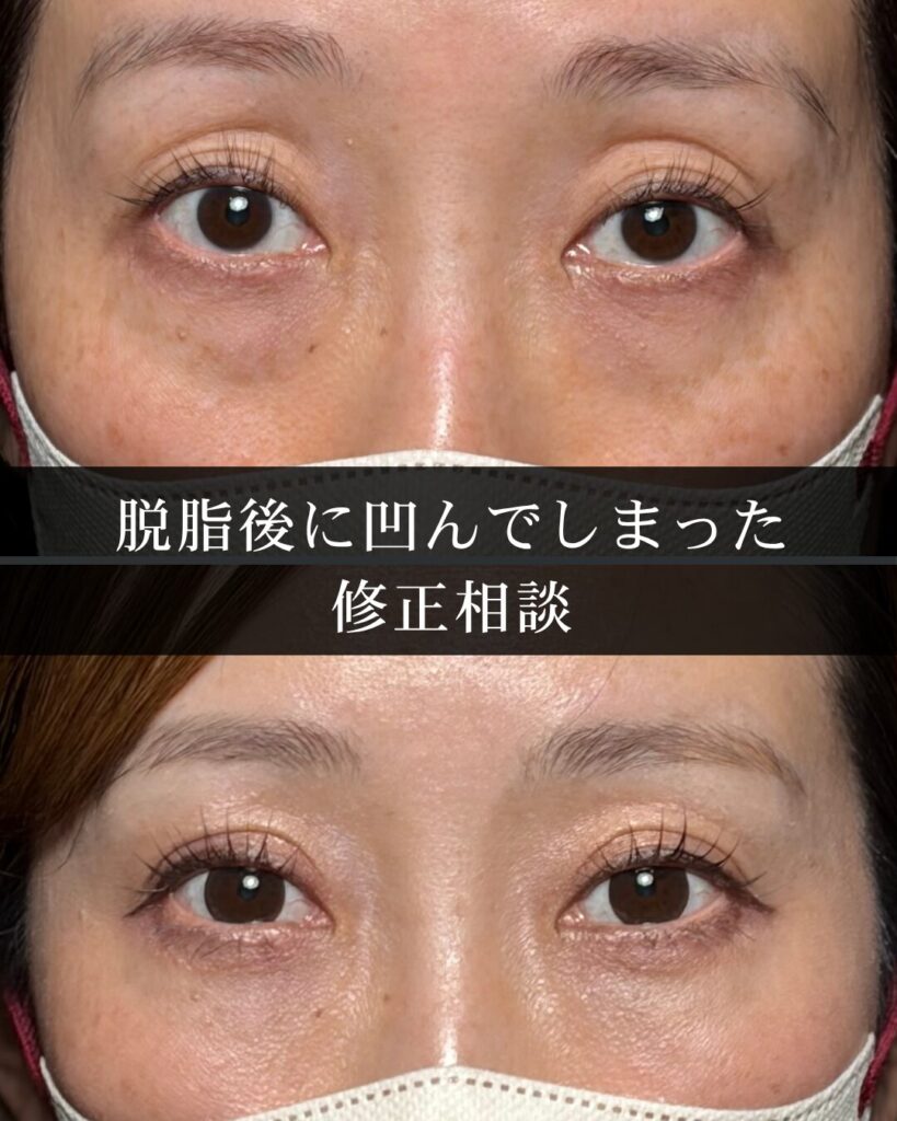 脱脂後に凹んでしまった場合の修正相談|知っておきたい対処の考え方