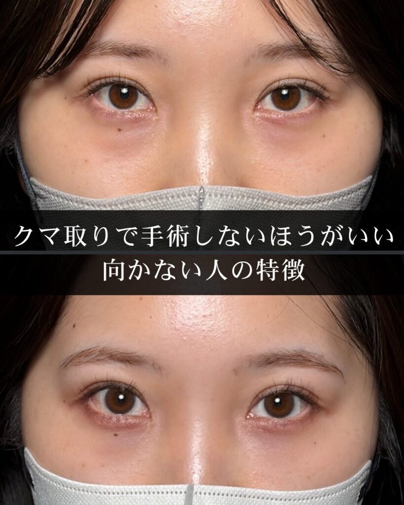 クマ取りで手術しないほうがいいケース|向かない人の特徴を解説