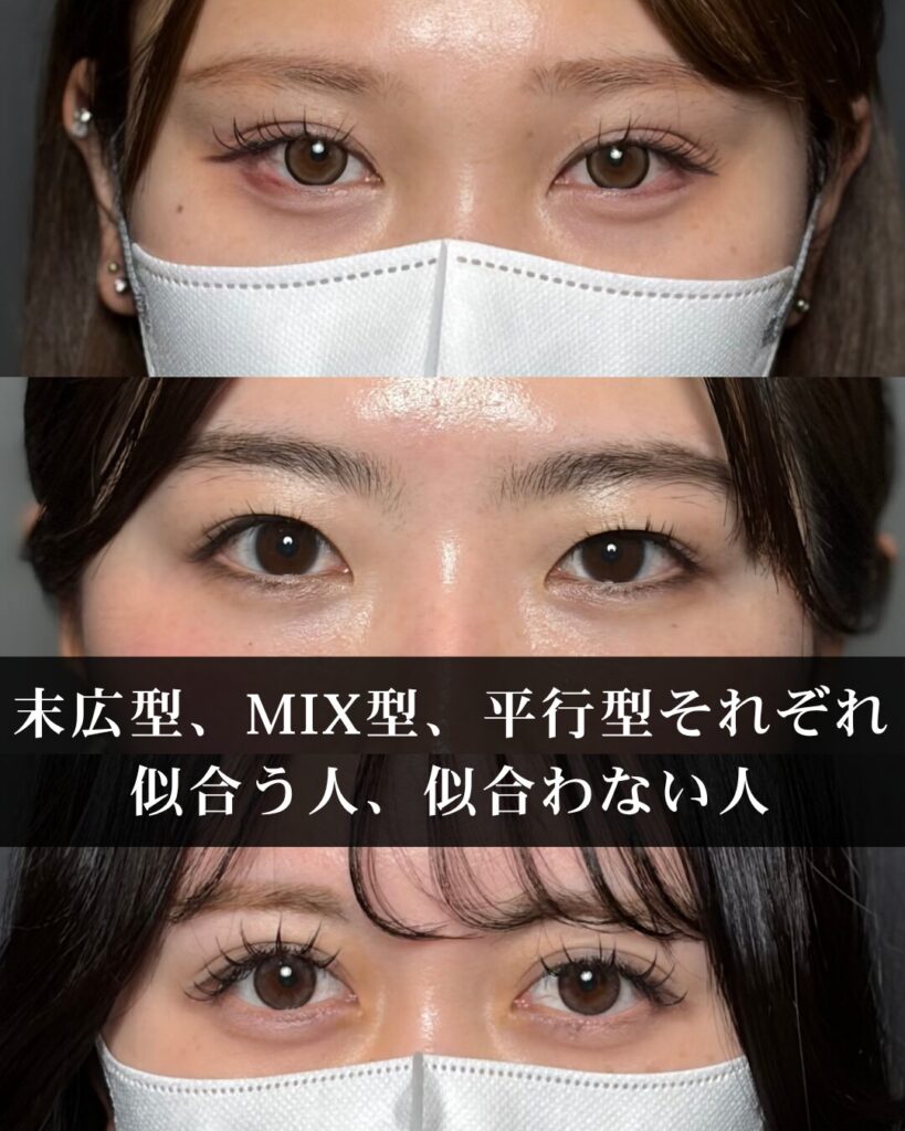 仙台で二重整形の名医が解説|末広型、MIX型、平行型それぞれ似合う人、似合わない人