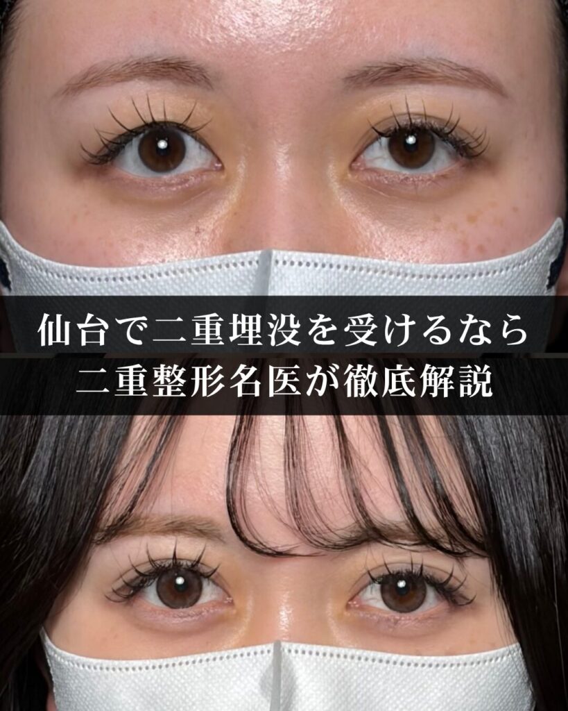 仙台で二重埋没を受けるなら。二重整形名医が徹底解説