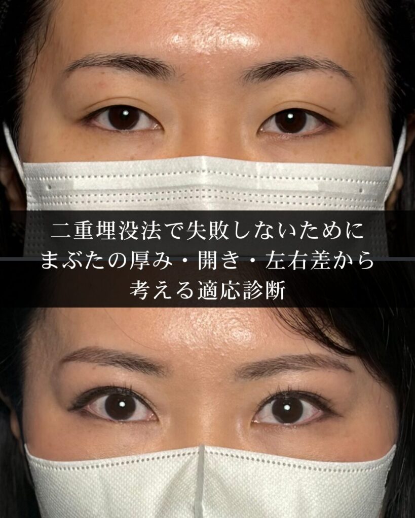 二重埋没法で失敗しないために|まぶたの厚み・開き・左右差から考える適応診断