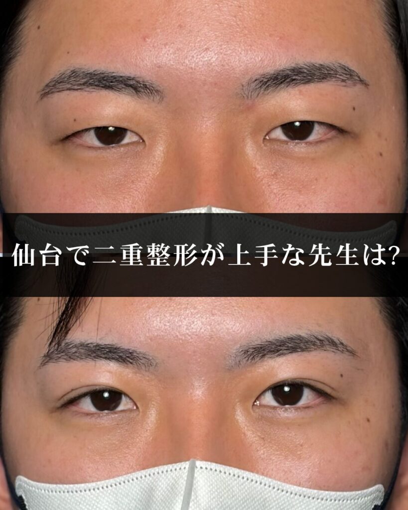 仙台で二重整形が上手な先生は?目元整形の症例が豊富なドクターの選び方【2026年最新】