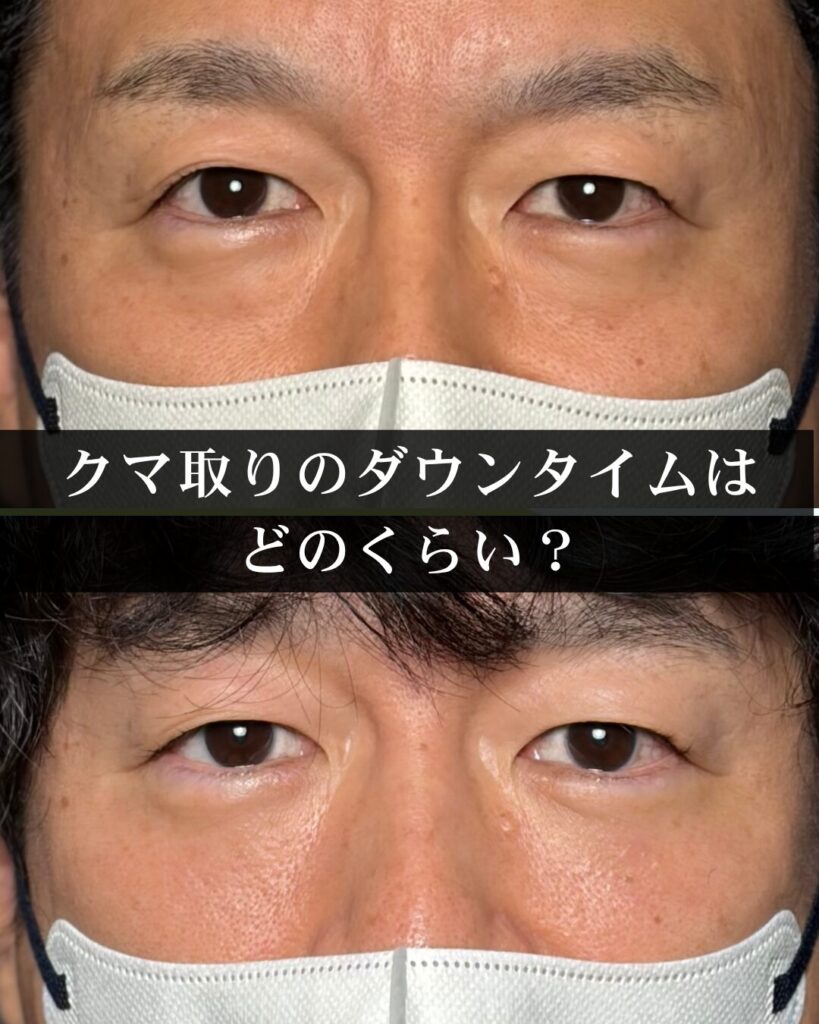クマ取りのダウンタイムはどのくらい?脱脂・裏ハムラ・切開ハムラの腫れと休みの目安を仙台の外科専門医が解説【2026年最新】