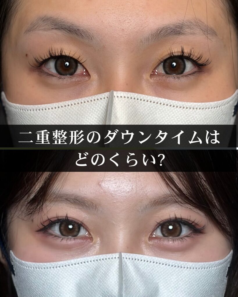 二重整形のダウンタイムはどのくらい?腫れ方・術式の違い・名医選びを仙台の外科専門医が解説【2026年最新】